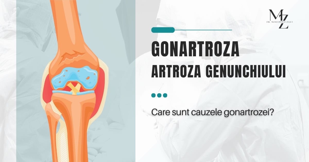 Gonartroza - drmohammedzejly.ro